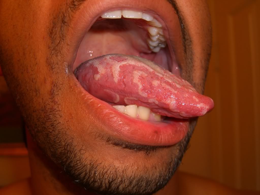 White Pattern Tongue | odd white patterns on tongue ears nose mouth throat White Pattern Tongue | odd white patterns on tongue ears nose mouth throat