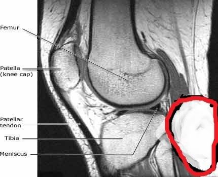 mskel-mr-knee-lat1.jpg