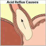 acid reflux causes image 
