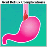 acid reflux complications image