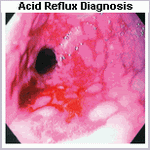 acid reflux diagnosis image 