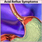 acid reflux symptoms image