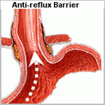 anti-reflux barrier image