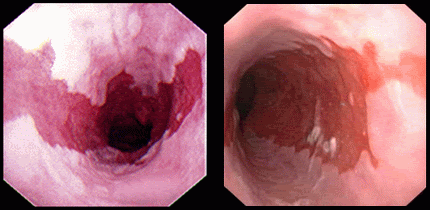 Endoscopy for Barrett's esophagus