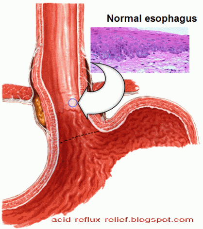 Barrett's esophagus graphics