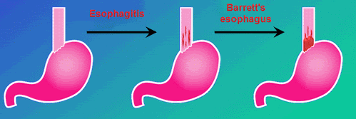 Acid Reflux Complications image