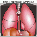 extraesophageal symptoms image