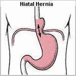 hiatal hernia image