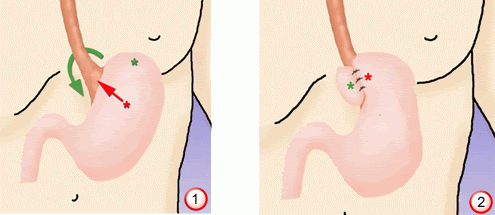 Surgery for acid reflux relief image